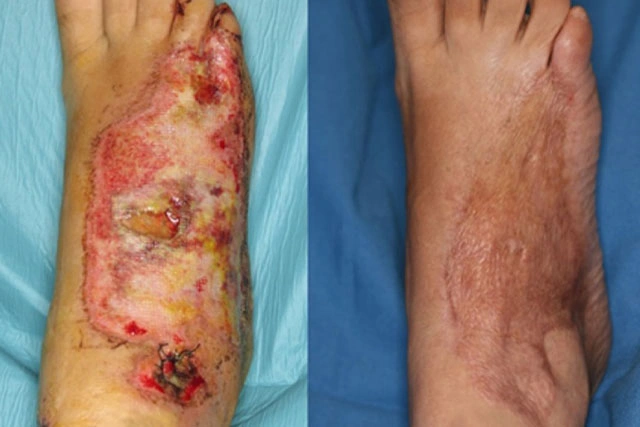 Dr. Diego García Caballero atención especializada en pie diabético, angiología, cirugía vascular, heridas, quemaduras y terapia VAC