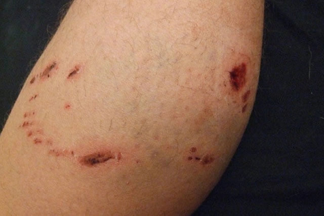 Dr. Diego García Caballero atención especializada en pie diabético, angiología, cirugía vascular, heridas, quemaduras y terapia VAC
