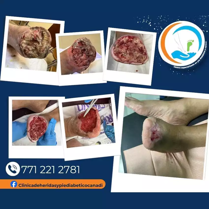 Dr. Diego García Caballero atención especializada en pie diabético, angiología, cirugía vascular, heridas, quemaduras y terapia VAC