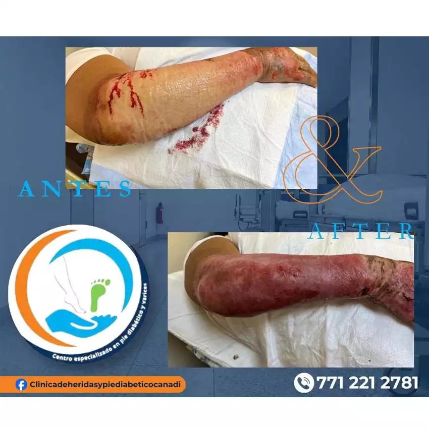 Dr. Diego García Caballero atención especializada en pie diabético, angiología, cirugía vascular, heridas, quemaduras y terapia VAC