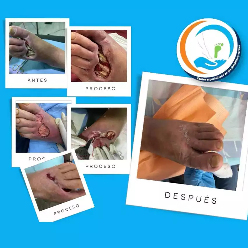 Dr. Diego García Caballero atención especializada en pie diabético, angiología, cirugía vascular, heridas, quemaduras y terapia VAC