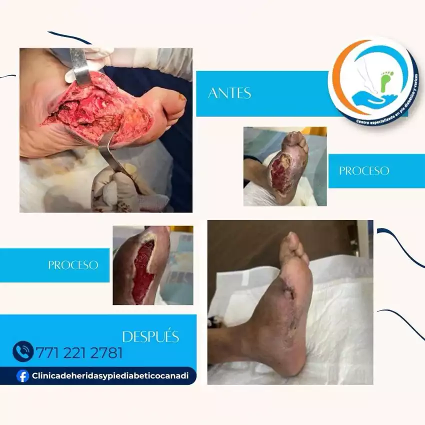 Dr. Diego García Caballero atención especializada en pie diabético, angiología, cirugía vascular, heridas, quemaduras y terapia VAC
