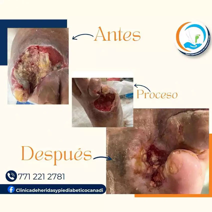 Dr. Diego García Caballero atención especializada en pie diabético, angiología, cirugía vascular, heridas, quemaduras y terapia VAC