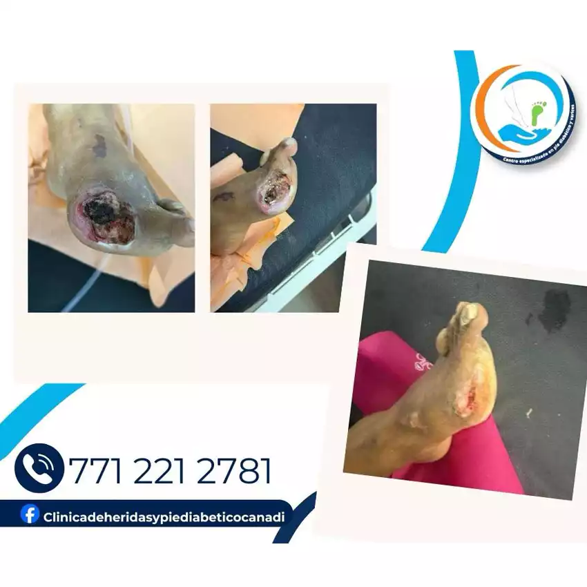 Dr. Diego García Caballero atención especializada en pie diabético, angiología, cirugía vascular, heridas, quemaduras y terapia VAC