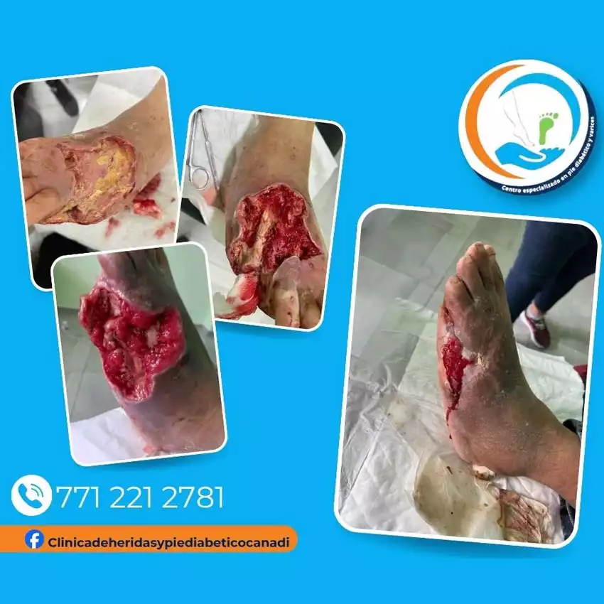 Dr. Diego García Caballero atención especializada en pie diabético, angiología, cirugía vascular, heridas, quemaduras y terapia VAC