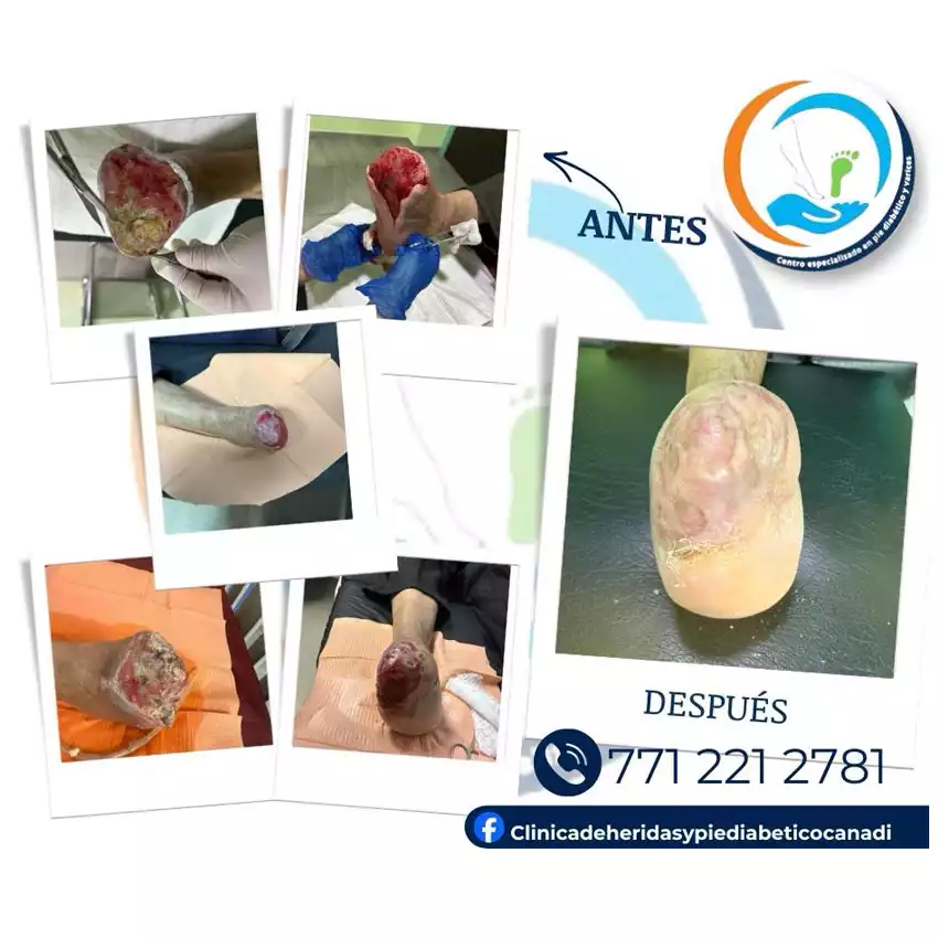 Dr. Diego García Caballero atención especializada en pie diabético, angiología, cirugía vascular, heridas, quemaduras y terapia VAC