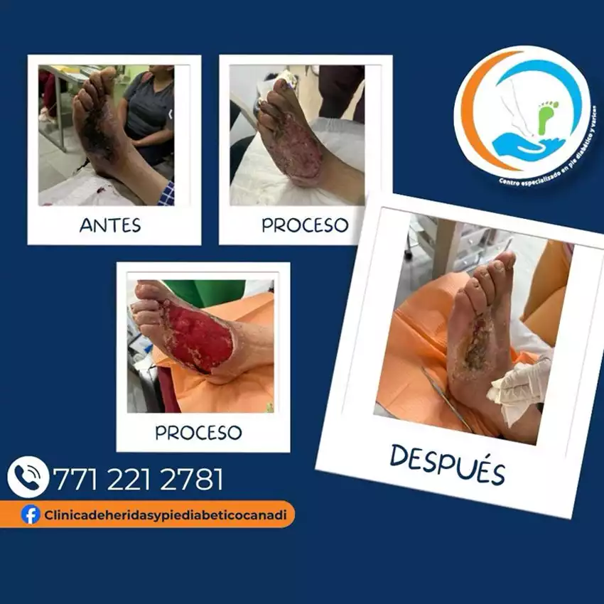 Dr. Diego García Caballero atención especializada en pie diabético, angiología, cirugía vascular, heridas, quemaduras y terapia VAC