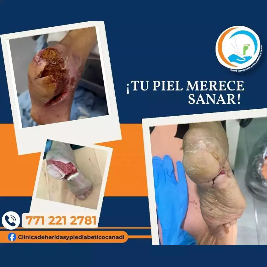 Dr. Diego García Caballero atención especializada en pie diabético, angiología, cirugía vascular, heridas, quemaduras y terapia VAC