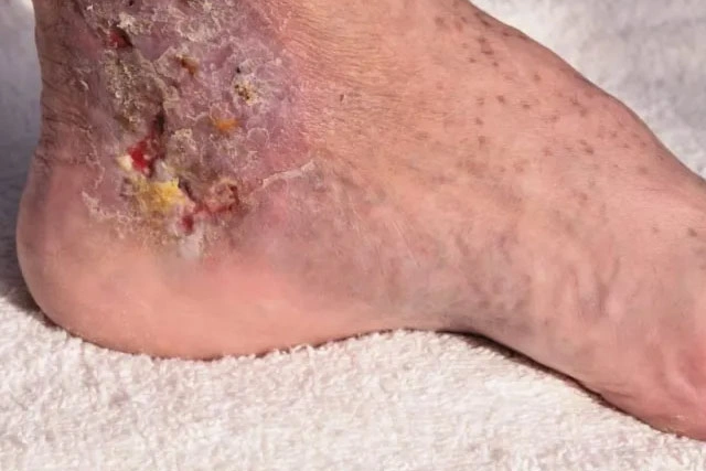 Dr. Diego García Caballero atención especializada en pie diabético, angiología, cirugía vascular, heridas, quemaduras y terapia VAC