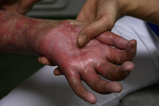 Dr. Diego García Caballero atención especializada en pie diabético, angiología, cirugía vascular, heridas, quemaduras y terapia VAC