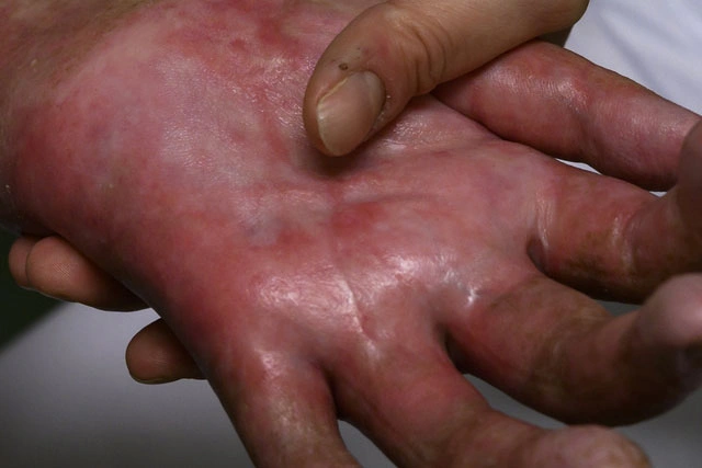 Dr. Diego García Caballero atención especializada en pie diabético, angiología, cirugía vascular, heridas, quemaduras y terapia VAC