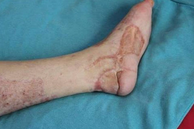 Dr. Diego García Caballero atención especializada en pie diabético, angiología, cirugía vascular, heridas, quemaduras y terapia VAC