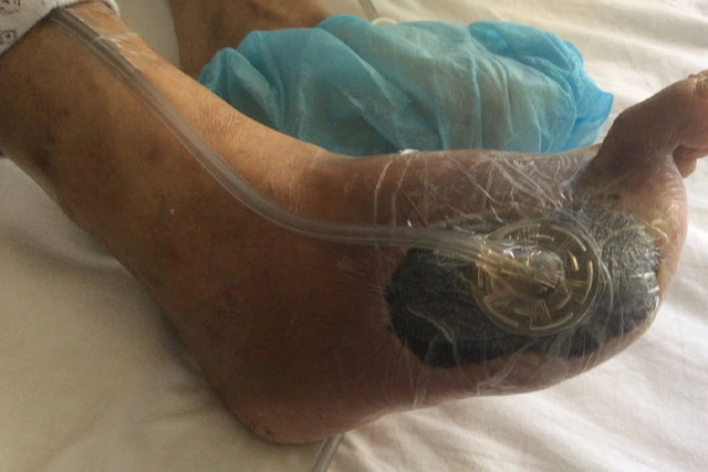 Dr. Diego García Caballero atención especializada en pie diabético, angiología, cirugía vascular, heridas, quemaduras y terapia VAC