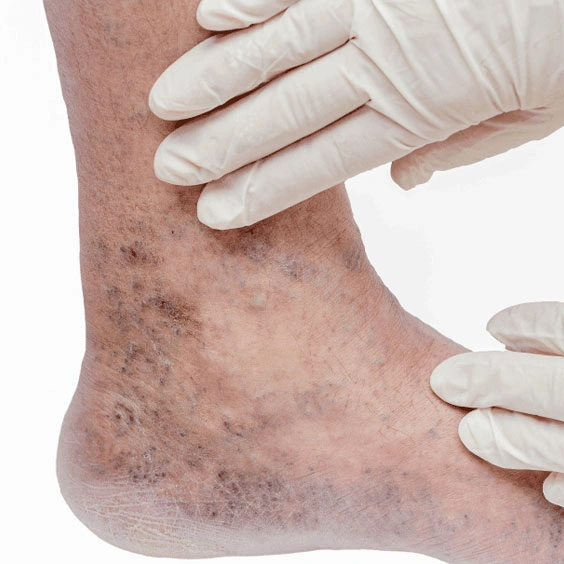 Dr. Diego García Caballero atención especializada en pie diabético, angiología, cirugía vascular, heridas, quemaduras y terapia VAC