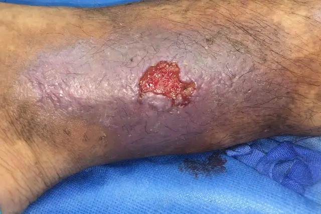Dr. Diego García Caballero atención especializada en pie diabético, angiología, cirugía vascular, heridas, quemaduras y terapia VAC
